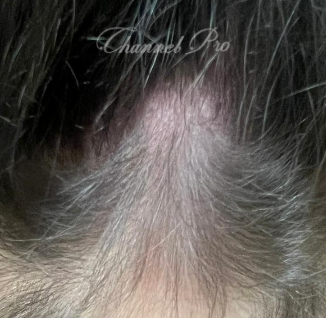 channel pro, no.1 microchanneling device, advanced microneedling , channel pro before after photo