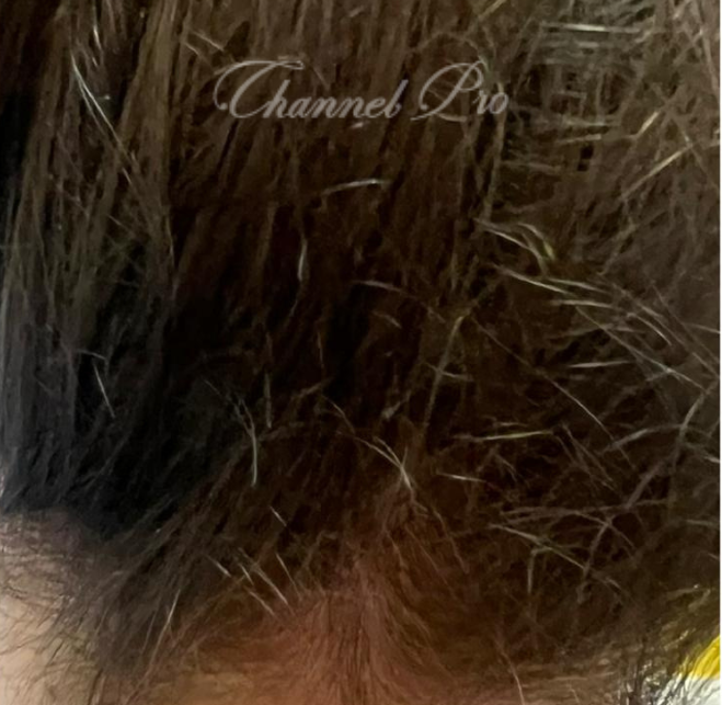 channel pro, no.1 microchanneling device, advanced microneedling , channel pro before after photo