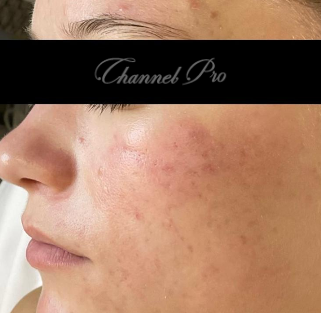 channel pro, no.1 microchanneling device, advanced microneedling , channel pro before after photo
