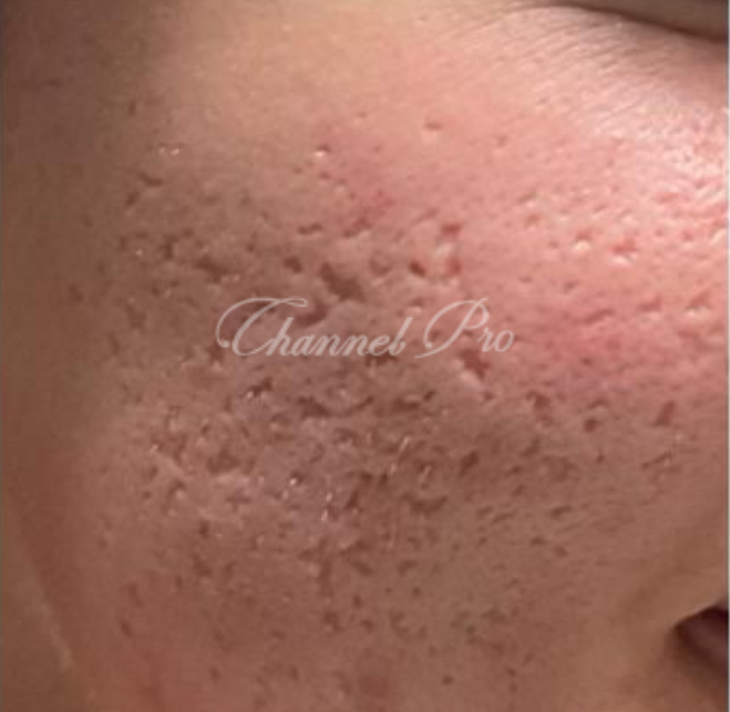 channel pro, no.1 microchanneling device, advanced microneedling , channel pro before after photo