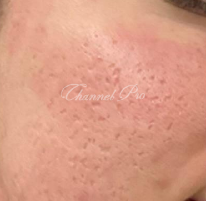 channel pro, no.1 microchanneling device, advanced microneedling , channel pro before after photo
