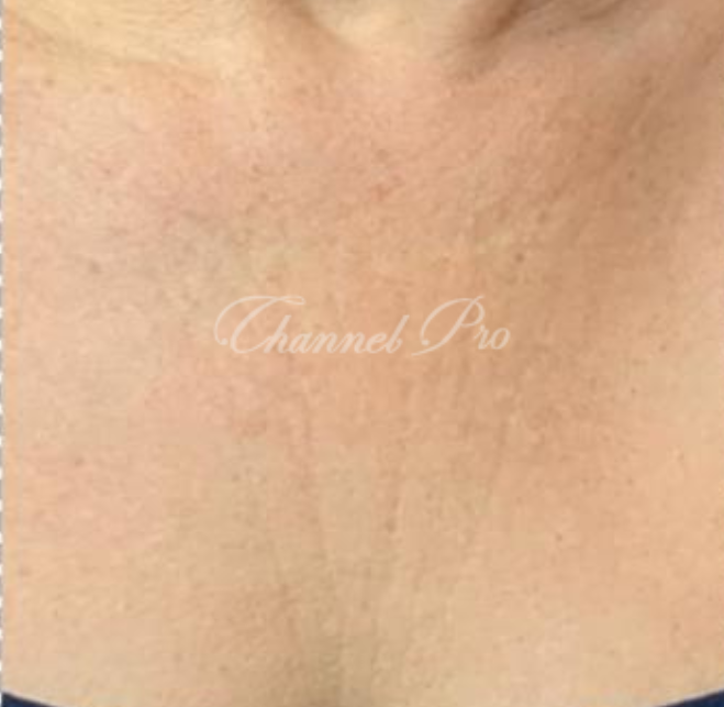 channel pro, no.1 microchanneling device, advanced microneedling , channel pro before after photo