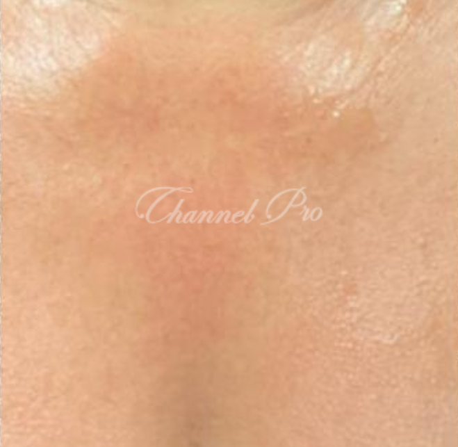 channel pro, no.1 microchanneling device, advanced microneedling , channel pro before after photo