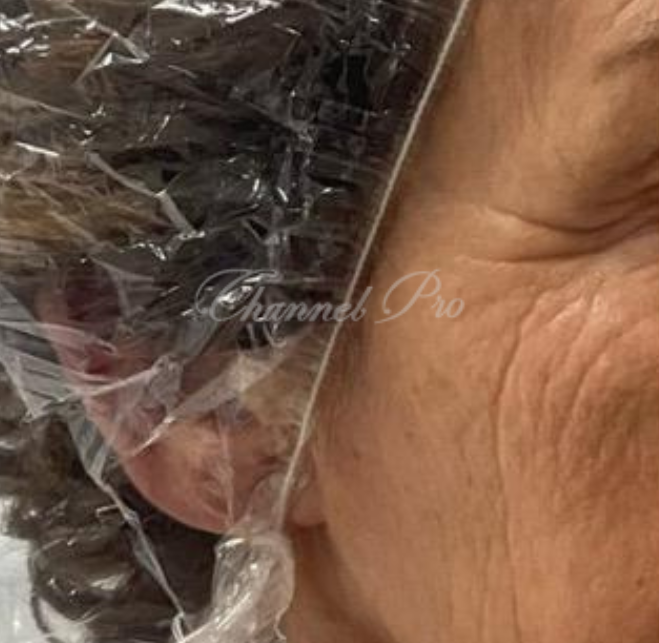 channel pro, no.1 microchanneling device, advanced microneedling , channel pro before after photo
