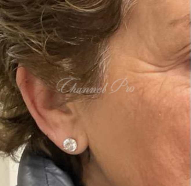 channel pro, no.1 microchanneling device, advanced microneedling , channel pro before after photo