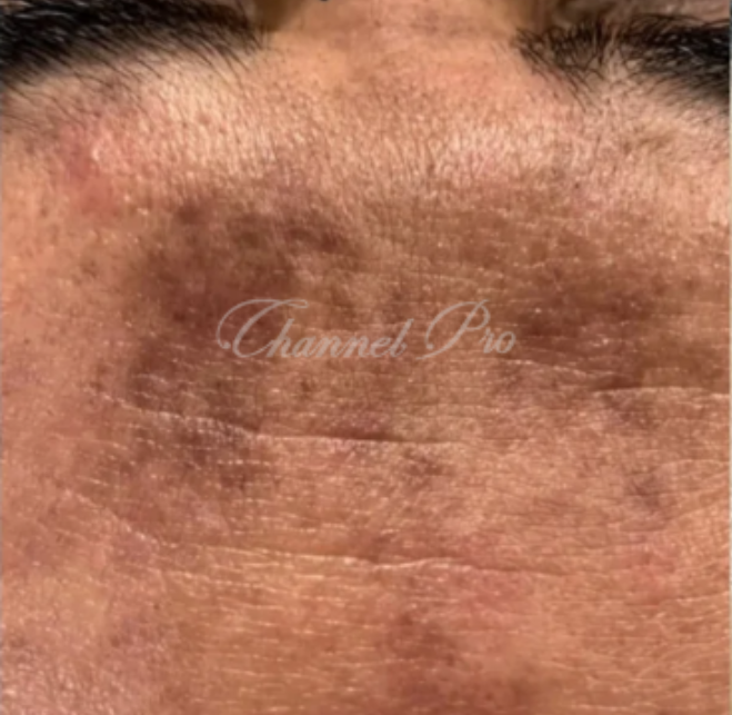 channel pro, no.1 microchanneling device, advanced microneedling , channel pro before after photo