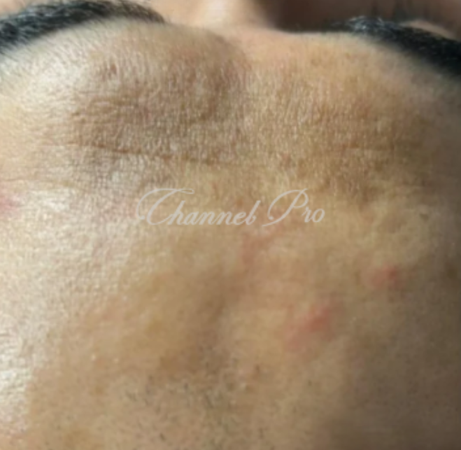 channel pro, no.1 microchanneling device, advanced microneedling , channel pro before after photo