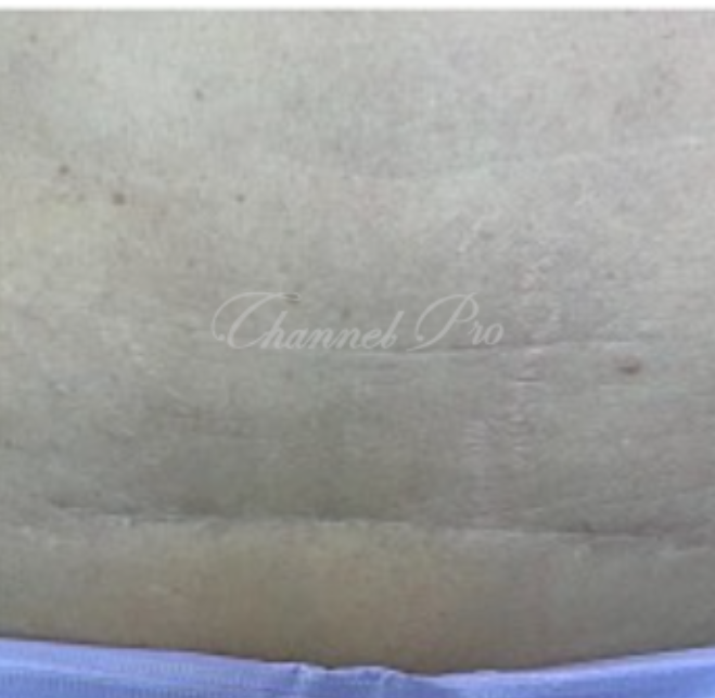 channel pro, no.1 microchanneling device, advanced microneedling , channel pro before after photo