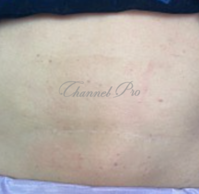 channel pro, no.1 microchanneling device, advanced microneedling , channel pro before after photo