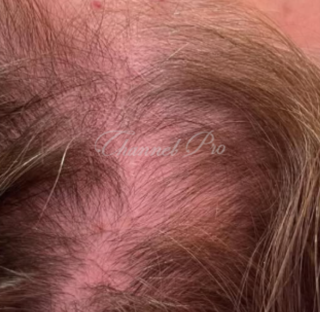 channel pro, no.1 microchanneling device, advanced microneedling , channel pro before after photo