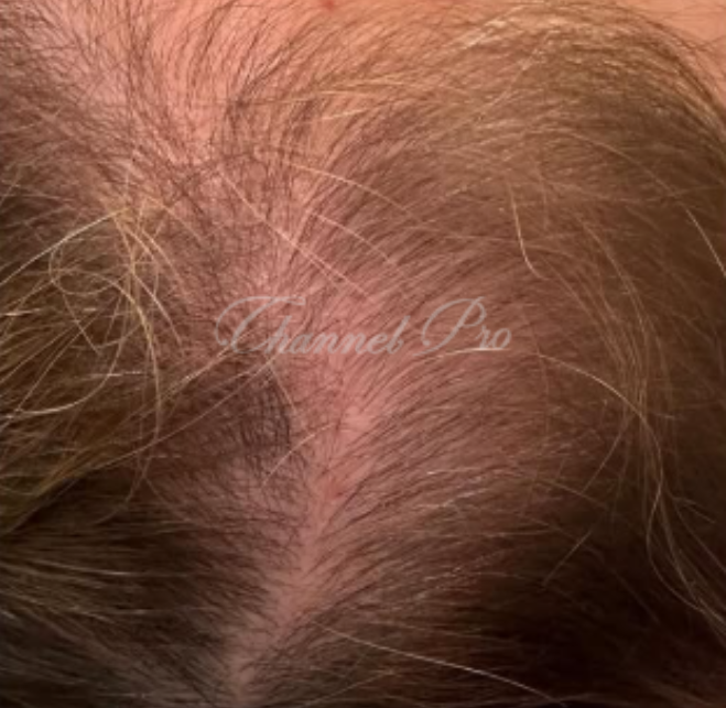 channel pro, no.1 microchanneling device, advanced microneedling , channel pro before after photo